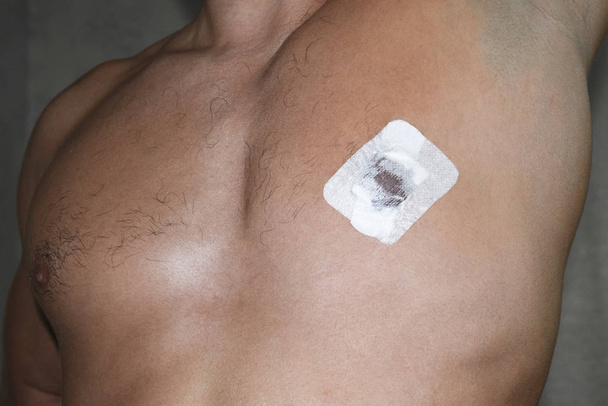 Bactericidal adhesive tape on the male nipple. Dressing after surgery on the nipple areola. - Foto, Imagem