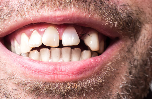 κενό δοντιών μετά από μια χειρουργική επέμβαση κύστης - Φωτογραφία, εικόνα