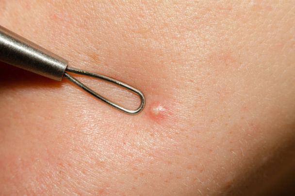 abscesso branco na pele do rosto com um laço de ferramenta cosmética para limpar cravos close-up
 - Foto, Imagem
