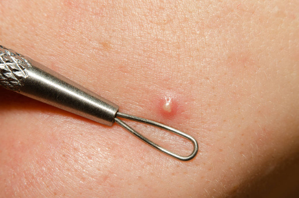 λευκό σπυράκι στο δέρμα του προσώπου με βρόχο καλλυντικού εργαλείου για τον καθαρισμό των μαύρων κεφαλών close-up - Φωτογραφία, εικόνα
