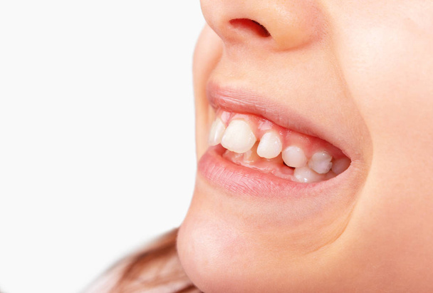 mond van een kind met permanente gebarsten tanden - Foto, afbeelding