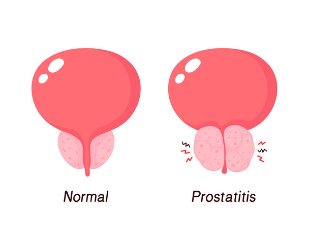 Normální prostata a benigní hyperplazie prostaty - Vektor, obrázek