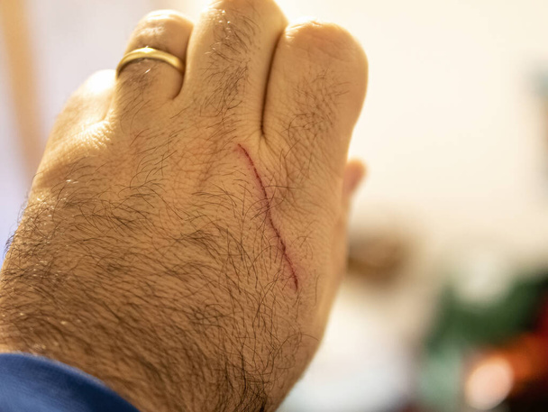 Arranhão de gato na mão humana
 - Foto, Imagem
