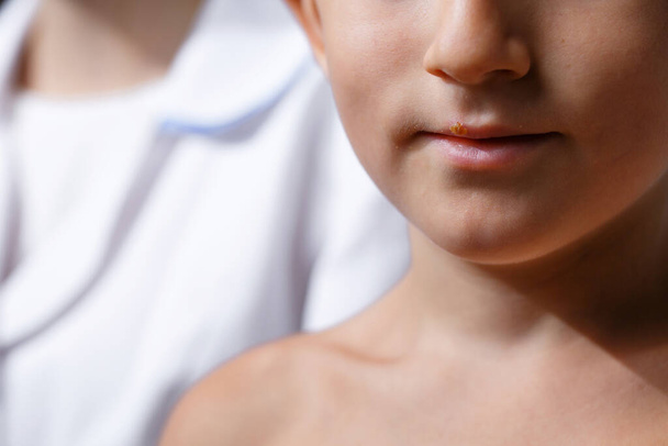 close-up de um menino pequeno com herpes no lábio
 - Foto, Imagem