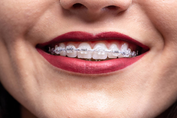 Kissable lips, white teeth, and braces - Photo, Image