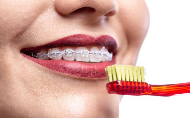 Gros plan des dents blanches avec des accolades
  - Photo, image