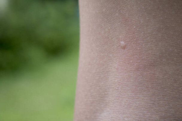 распухшая кожа от укусов комаров - Фото, изображение