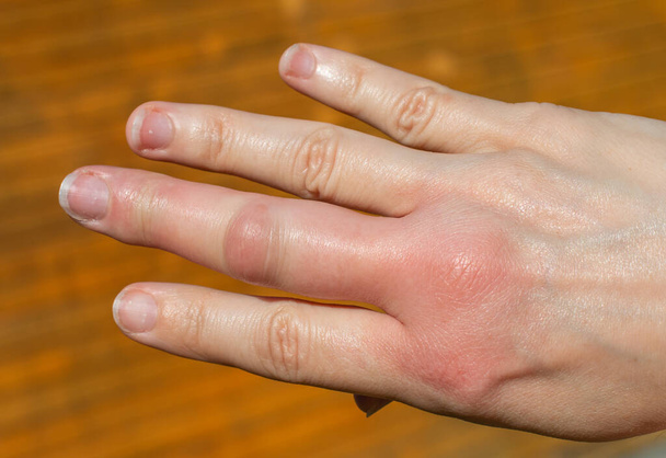 a right hand after a bee bite, swelling hand, swollen finger, hand after a bee sting - Fotoğraf, Görsel
