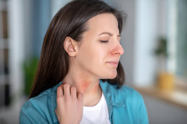 Allergic woman having red spots on her neck - 写真・画像