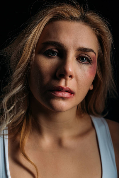 Frustrated Victim with bruises on face looking at camera isolated on black  - Foto, imagen