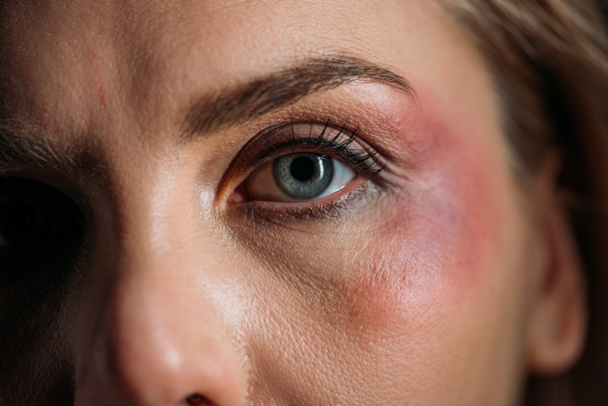 Gewassen gezicht van het slachtoffer met blauwe plekken naast het oog - Foto, afbeelding