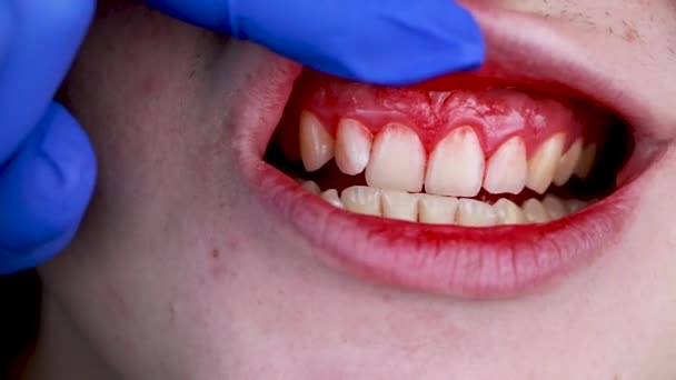 Krvácení z dásní a zánět zblízka. Muž, kterého vyšetřil zubař. Diagnóza zánětu dásní - Záběry, video