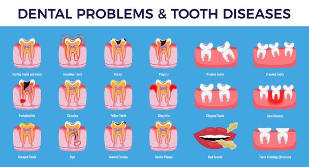 Zahnprobleme Krankheiten Infografik Set  - Vektor, Bild