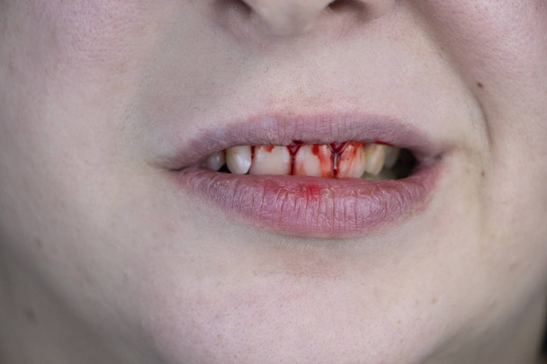 У человека кровь на зубах, сильное кровотечение десен после удара в челюсть. Крупный план зубов после драки или синяка
 - Фото, изображение