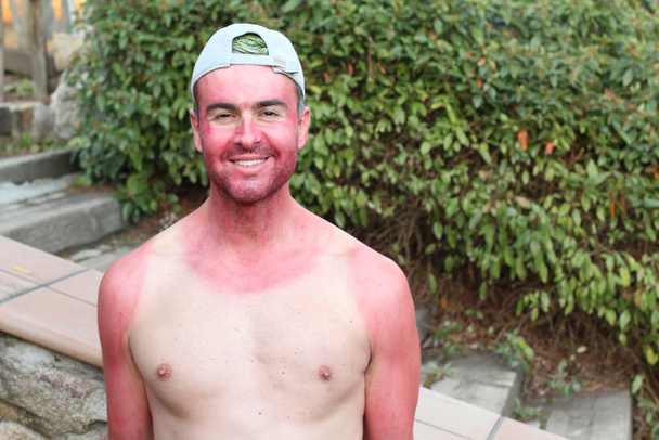 Giovane uomo scottato dal sole con linee abbronzanti estreme
 - Foto, immagini