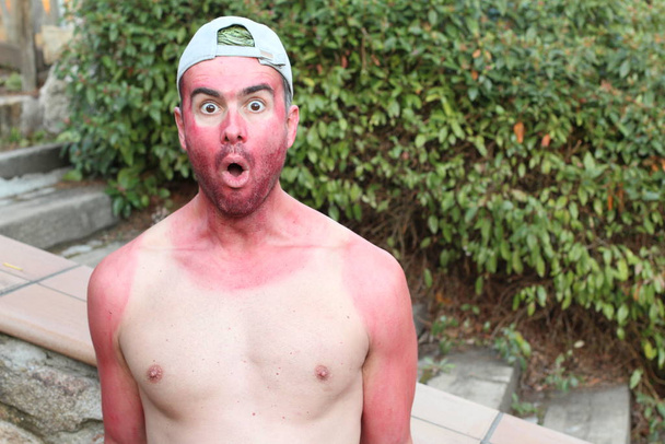 Sunburned young man with extreme tan lines - Photo, Image