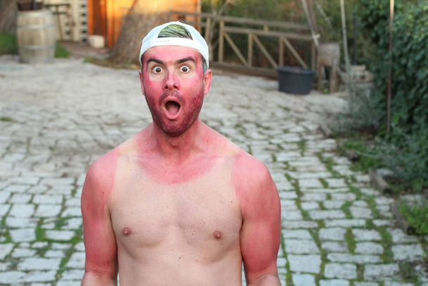 Hombre joven quemado por el sol con líneas de bronceado extremo
 - Foto, Imagen