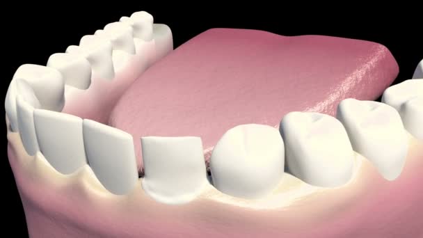 Tämä video näyttää hampaiden laminaatit
 - Materiaali, video