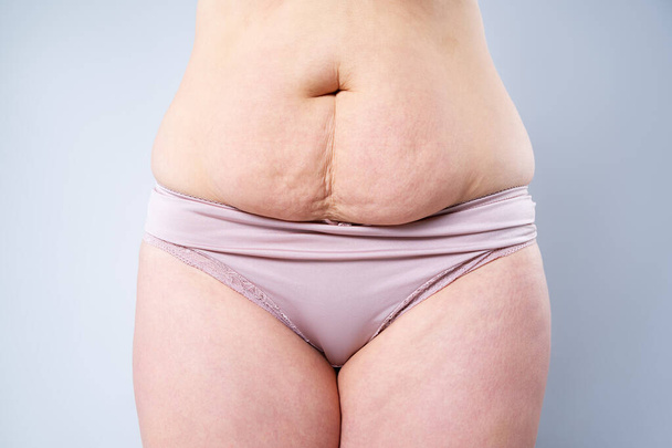 Tummy tuck, flabby skin on a fat belly, plastic surgery concept - Фото, изображение