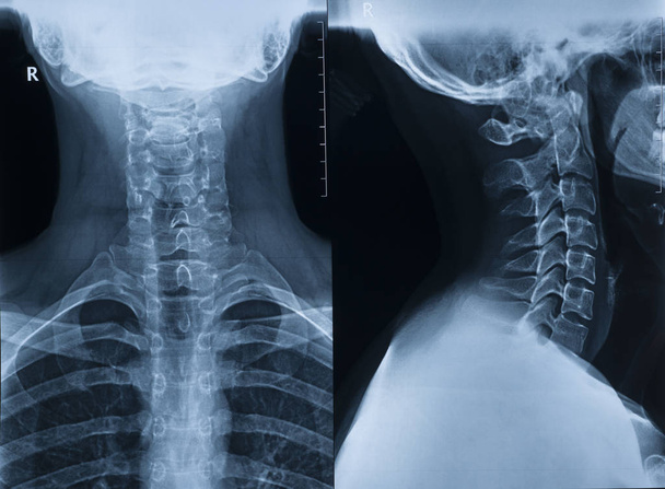 Röntgenbild der Halswirbelsäule eines Mannes in zwei Projektionen in Vollsicht und Profil - Foto, Bild