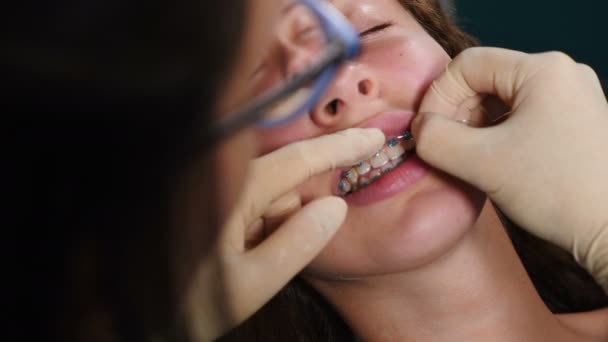 Processo de instalação de aparelho dentário no paciente, close-up. Tratamento Ortodôntico. Dentes com aparelho dentário. Correcção de mordida. Ortodontista a trabalhar. Jovem atraente visitando ortodontista na moderna
 - Filmagem, Vídeo