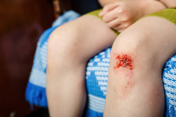 mała dziewczynka zraniła się w kolano - Zdjęcie, obraz