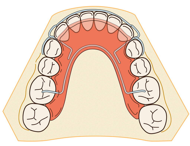 Verwijderbaar orthodontisch apparaat wordt gebruikt na orthodontische behandeling voor retentie - Foto, afbeelding