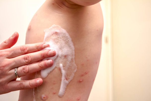 La terapia contro il virus della varicella ha morbillo, varicella
, - Foto, immagini