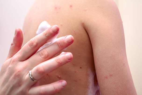 Terapia contra el virus de la varicela tiene sarampión, varicela
, - Foto, Imagen