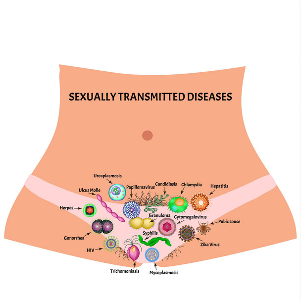 Viral ve bakteriyel enfeksiyonlar. Cinsel yolla bulaşan hastalıklar. Bilgi grafikleri. İzole edilmiş arkaplanda vektör illüstrasyonu. - Vektör, Görsel
