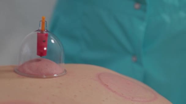 Doctor removes vacuum cans from the back of a man. - Felvétel, videó