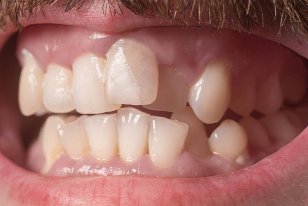 Κοντινό πλάνο πολύ στραβών δοντιών σε έναν ενήλικο γενειοφόρο. Δεν είναι το σωστό δάγκωμα. Όχι υγιή δόντια. Παραβίαση της θέσης των δοντιών στα σαγόνια - Φωτογραφία, εικόνα