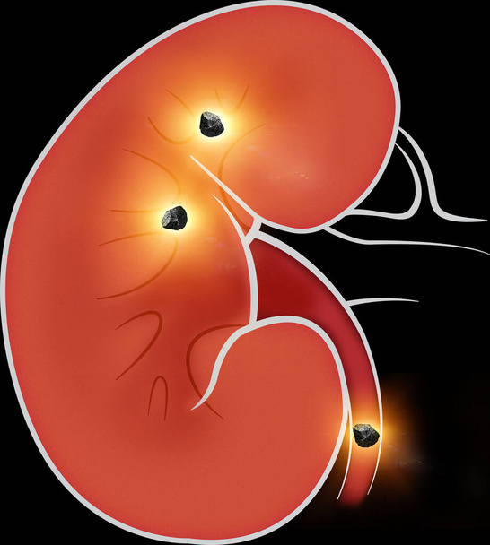 Menselijk lichaamsbeeld van nieren. De nieren zijn twee boonvormige organen gevonden in gewervelde dieren. Nierstenen.  - Foto, afbeelding