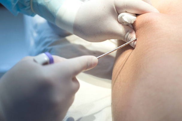 An oncologist, using a long needle, pierces a childs ilium to diagnose bone marrow for leukemia, Ewings sarcoma - Photo, Image