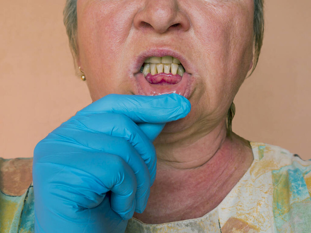 Periodontitis, een ontstekingsproces in het tandvlees. Blootstelling van  - Foto, afbeelding