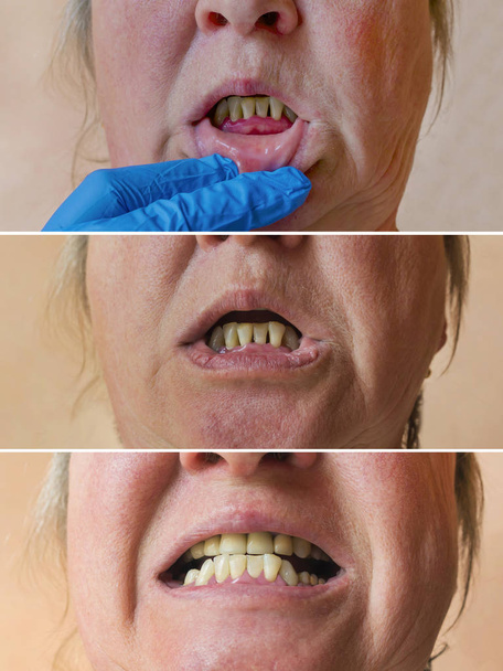 Der Zustand der Mundhöhle nach der Behandlung von Zahnfleischerkrankungen, - Foto, Bild