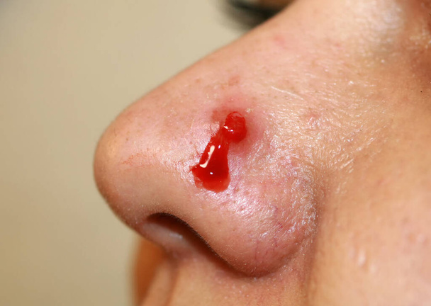 Bouton enflammé sur le nez. Acné kystique. L'acné sur la peau
 - Photo, image