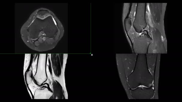 Vergelijking van Mri knie of Magnetische resonantie beeldvorming van kniegewricht roertechniek van axiale, sagittale en coronale weergave met sag t2 voor vetonderdrukking. - Video