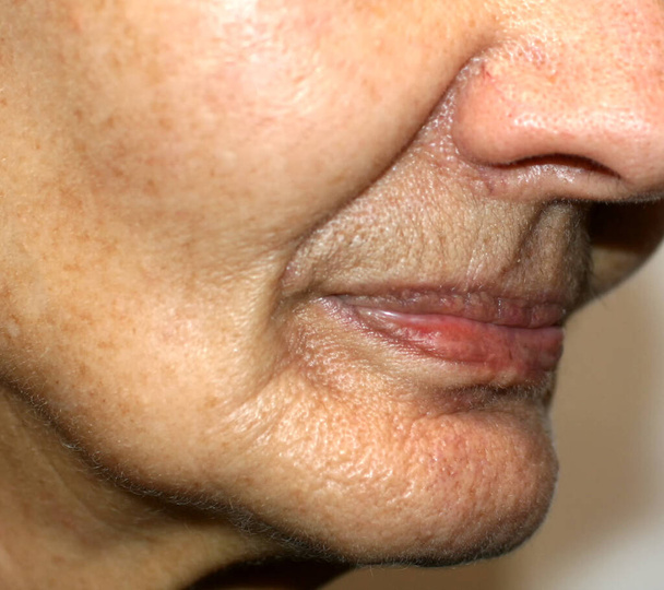 Nasolabiale rimpels. Rimpels op de huid van het gezicht van de nek. Wazige wangen en nek - Foto, afbeelding