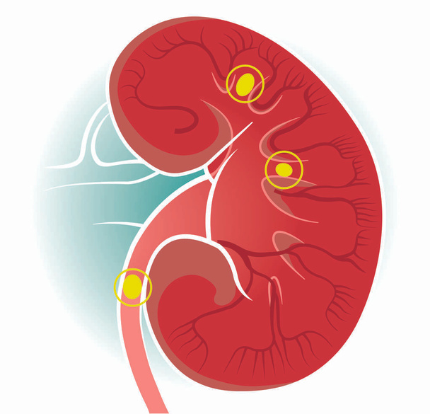 Das menschliche Körperbild der Nieren. Die Nieren sind zwei bohnenförmige Organe, die man bei Wirbeltieren findet. Nierensteine.  - Vektor, Bild