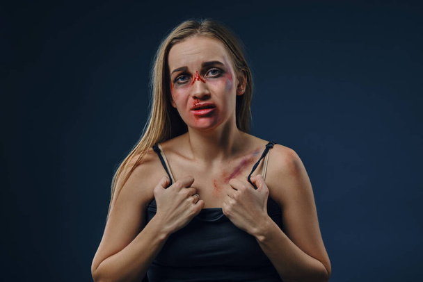 Girl with bruises on her face and chest holds on to her black t-shirt, posing sitting against blue studio background. Domestic violence. Close-up - Zdjęcie, obraz