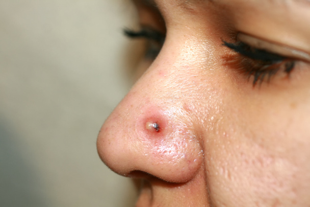 Inflamed pimple on nose. Cyst Acne. Acne on the skin - Photo, Image