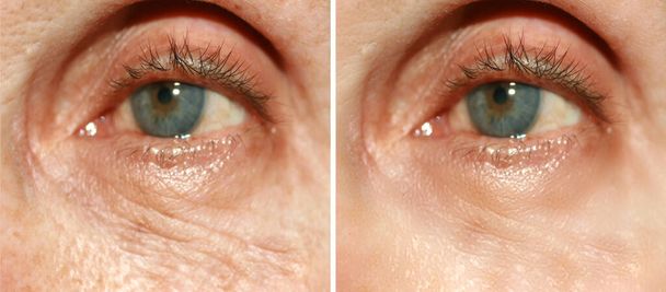 Wrinkles under the eyes. Wrinkles on the skin of the face. Flabby eyelids. Before and after treatment with a cosmetic procedure - Photo, Image
