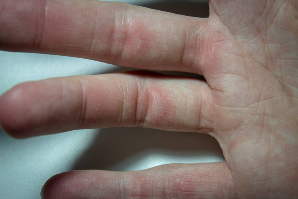 Χέρι με μικρούς κάλους μετά από μια σκληρή συνεδρία στο γυμναστήριο αναρρίχησης - Φωτογραφία, εικόνα