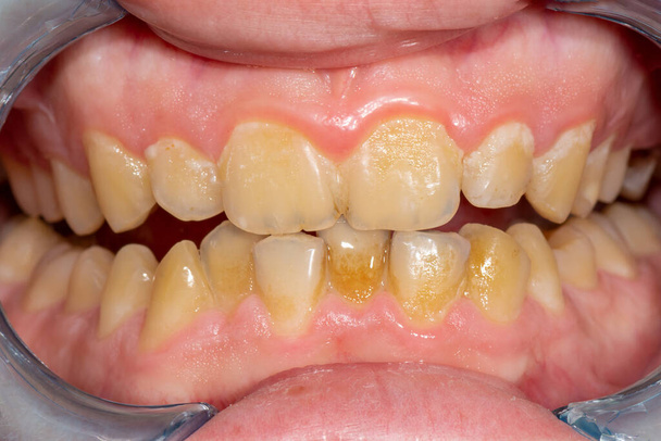 tartar close-up on the lower anterior incisors. Dental hygiene of teeth - Photo, Image