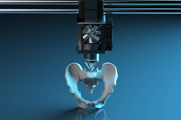 3d renderizado 3d impresora impresión prótesis de hueso de la cadera
 - Foto, Imagen