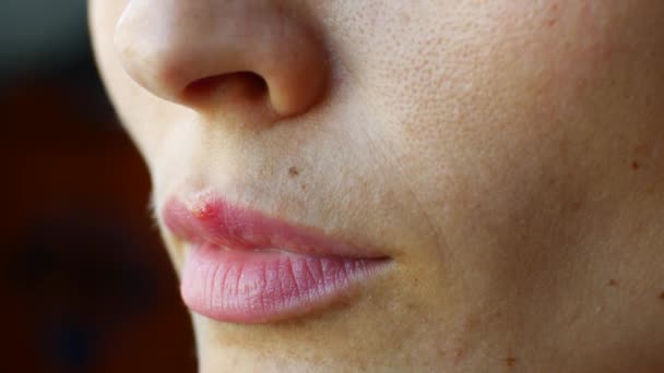 Herpes on the lip of a girl - Πλάνα, βίντεο