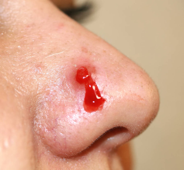 Brufolo infiammato sul naso. Acne cisti. Acne sulla pelle
 - Foto, immagini