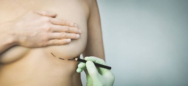 Plastische Chirurgie - Arzt markiert Frauenbrust für kosmetische Korrekturen auf grauem Hintergrund. Kopierraum - Foto, Bild