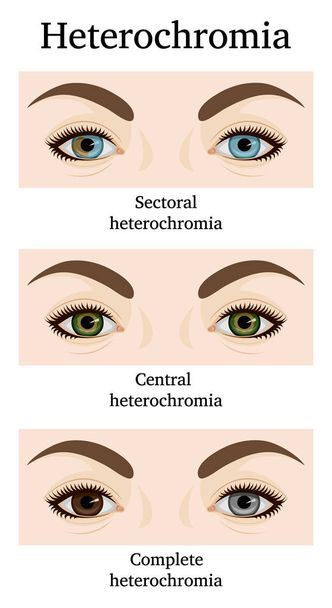 Illustration of Heterochromia iridum - Vector, Image